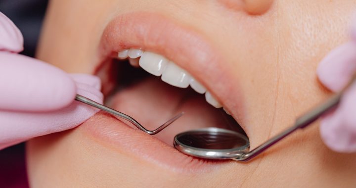 Professionelle Zahnreinigung – Vorbeugen statt Behandeln